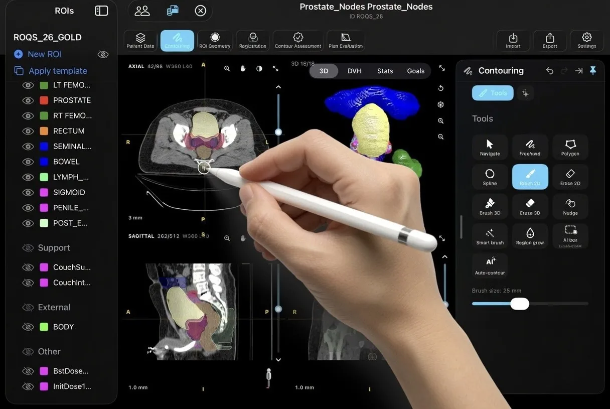 A hand using Apple Pencil to contour directly on an axial CT slice in RadContour, with the Brush 2D tool selected.